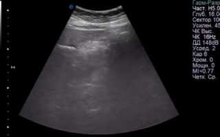 Причины и лечение острого отечного панкреатита: как и чем снять отёк поджелудочной железы?