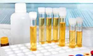 Почему при сахарном диабете у пациента обнаруживается ацетон в моче?