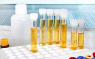 Почему при сахарном диабете у пациента обнаруживается ацетон в моче?