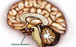 Аденома гипофиза: симптоматика и признаки заболевания у женщин