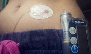 Инсулиновые помпы при сахарном диабете