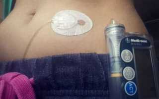 Инсулиновые помпы при сахарном диабете