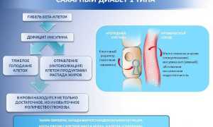 Стадии сахарного диабета: как их оценить и как избежать ухудшения состояния