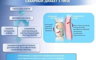 Стадии сахарного диабета: как их оценить и как избежать ухудшения состояния