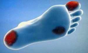 Начальная стадия гангрены нижних конечностей при сахарном диабете и как ее лечить