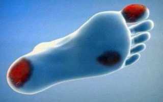 Начальная стадия гангрены нижних конечностей при сахарном диабете и как ее лечить