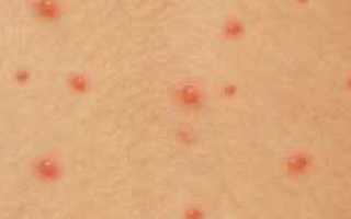 Кожные высыпания при сахарном диабете