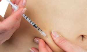 Почему при сахарном диабете часто развивается липодистрофия?