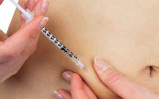 Почему при сахарном диабете часто развивается липодистрофия?