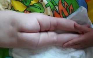 Почему не симметричны складочки на ножках у ребёнка?
