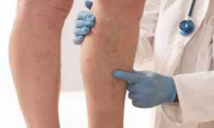 Лечение отеков ног при сахарном диабете