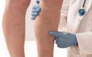 Лечение отеков ног при сахарном диабете