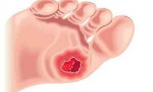 Средства для лечения трофической язвы нижних конечностей и ее фото