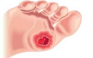 Средства для лечения трофической язвы нижних конечностей и ее фото