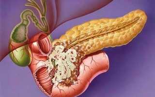 Рак головки поджелудочной железы