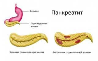 Классификация панкреатита