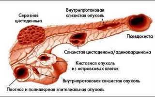 Полипы поджелудочной железы