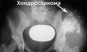 Лечение хондросаркомы