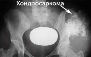 Лечение хондросаркомы