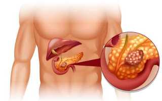 Поджелудочная железа при сахарном диабете