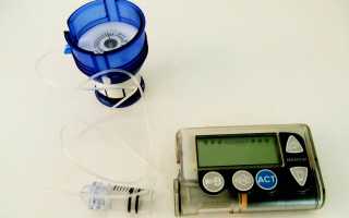 Микроинфузионная инсулиновая помпа – новое слово в лечении диабета