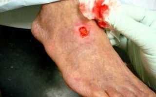 Особенности лечения трофических язв на ногах при сахарном диабете