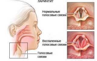 Эффективно ли применение антибиотиков при ларингите?