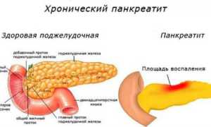 Заболевания поджелудочной железы и их симптомы