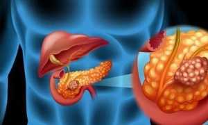 Проведение дренажа на поджелудочной железе: послеоперационная необходимость и результат
