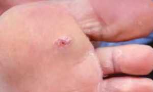 Диабетические язвы на ногах как выглядят, лечение