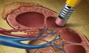 Болезнь почек при сахарном диабете