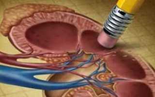 Болезнь почек при сахарном диабете