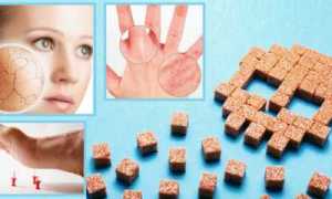 Первичные поражения кожи при сахарном диабете: типичные проявления, правила гигиены