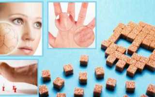 Первичные поражения кожи при сахарном диабете: типичные проявления, правила гигиены