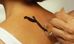 Лечение сахарного диабета пиявками (с отзывами о гирудотерапии)