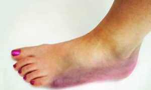 Гангрена нижних конечностей – следствие сахарного диабета