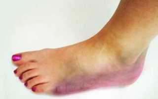 Гангрена нижних конечностей – следствие сахарного диабета