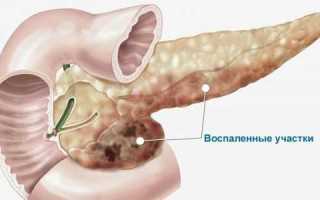 Ферментная недостаточность поджелудочной железы