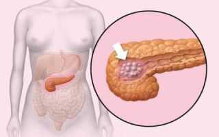 Инсулинома: как проявляется, чем опасна? Методы купирования приступов гипогликемии. Инсулинотерапия, как метод лечения шизофрении