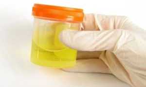 Глюкозурия на фоне сахарного диабета