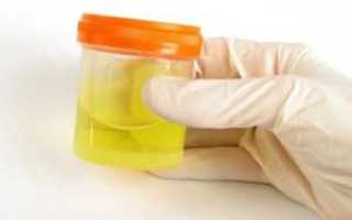 Глюкозурия на фоне сахарного диабета