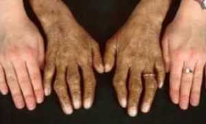 Что такое Гемохроматоз