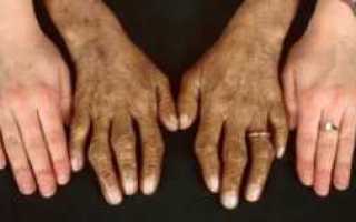 Что такое Гемохроматоз