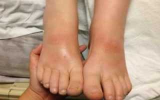 Характеристика, лечение и профилактика диабетической невропатии и трофической язвы при сахарном диабете