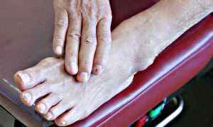 Диабетическая нейропатия нижних конечностей