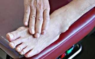 Диабетическая нейропатия нижних конечностей