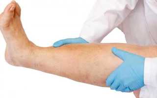 Отек ног при сахарном диабете