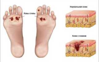 Лечение гнойных ран при сахарном диабете: факторы возникновения недуга,  современная терапия