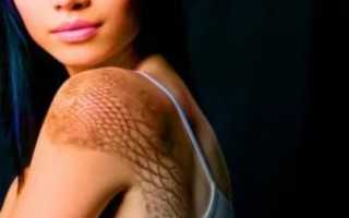 Возьмут ли в армию с ихтиозом?