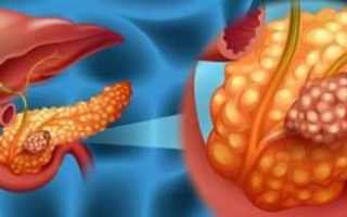 Рак поджелудочной железы